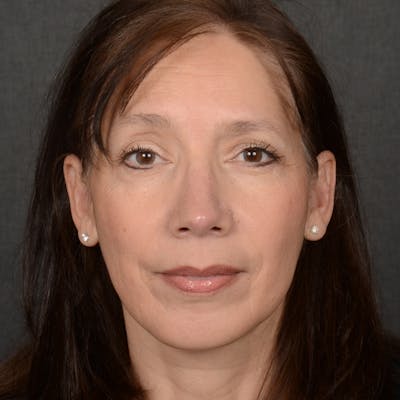 Chin Augmentation Before & After Gallery - Patient 642948 - Image 2