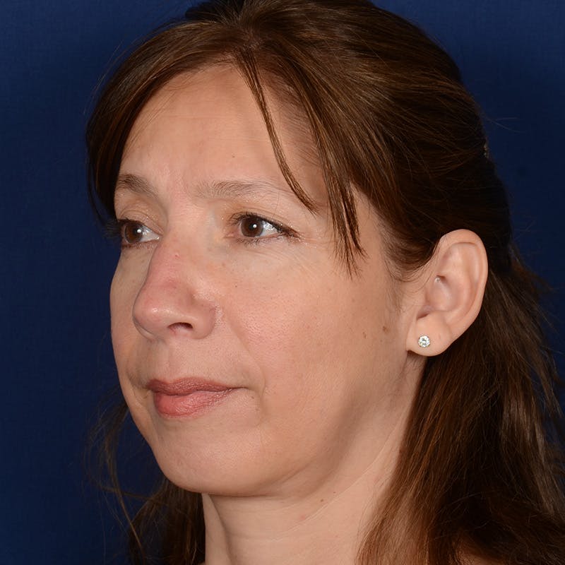 Chin Augmentation Before & After Gallery - Patient 642948 - Image 3