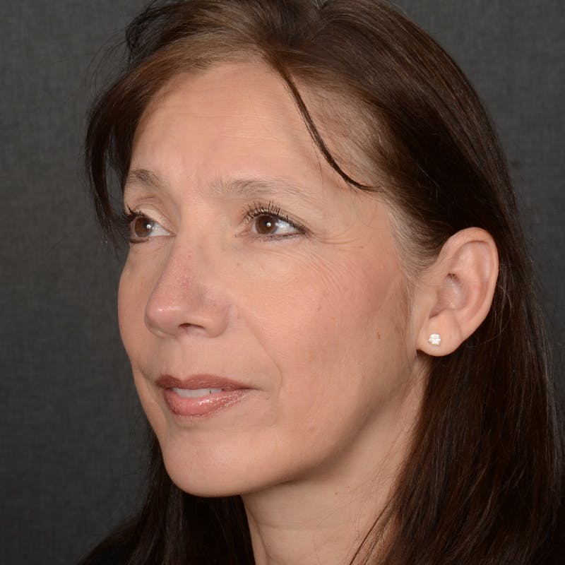 Chin Augmentation Before & After Gallery - Patient 642948 - Image 4