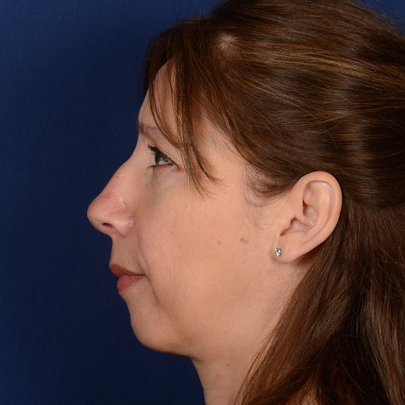 Chin Augmentation Before & After Gallery - Patient 642948 - Image 5