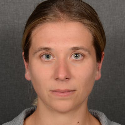 Female Rhinoplasty Before & After Gallery - Patient 221754 - Image 1