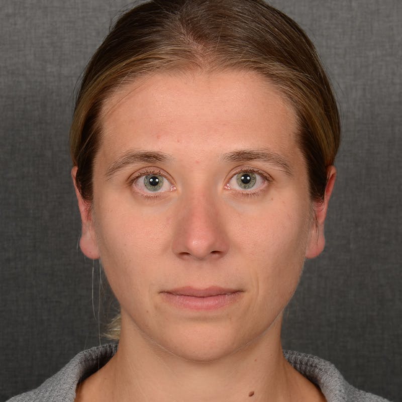 Chin Augmentation Before & After Gallery - Patient 236449 - Image 1