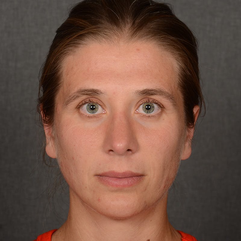 Chin Augmentation Before & After Gallery - Patient 236449 - Image 2