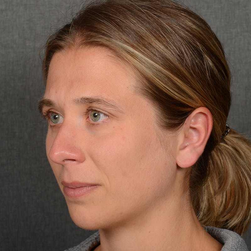 Chin Augmentation Before & After Gallery - Patient 236449 - Image 3