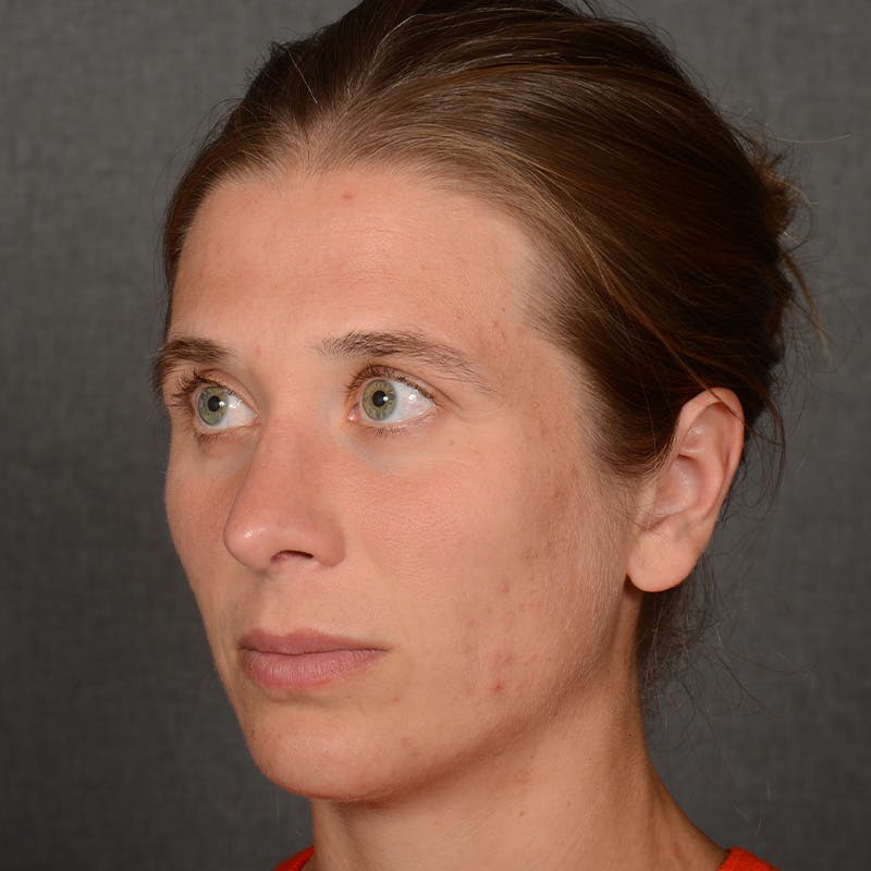 Chin Augmentation Before & After Gallery - Patient 236449 - Image 4