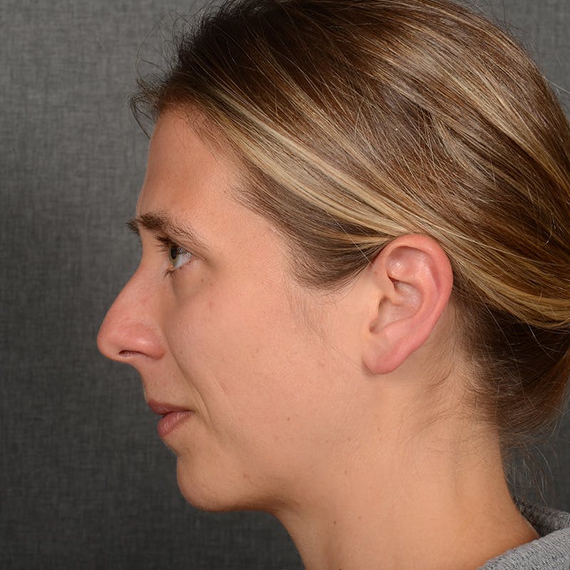 Chin Augmentation Before & After Gallery - Patient 236449 - Image 5