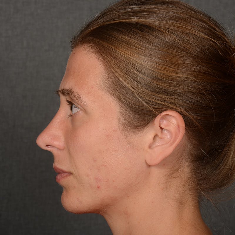Chin Augmentation Before & After Gallery - Patient 236449 - Image 6