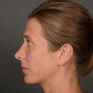 Chin Augmentation Before & After Gallery - Patient 236449 - Image 6