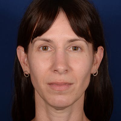 Chin Augmentation Before & After Gallery - Patient 121334 - Image 1