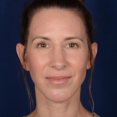 Chin Augmentation Before & After Gallery - Patient 121334 - Image 2