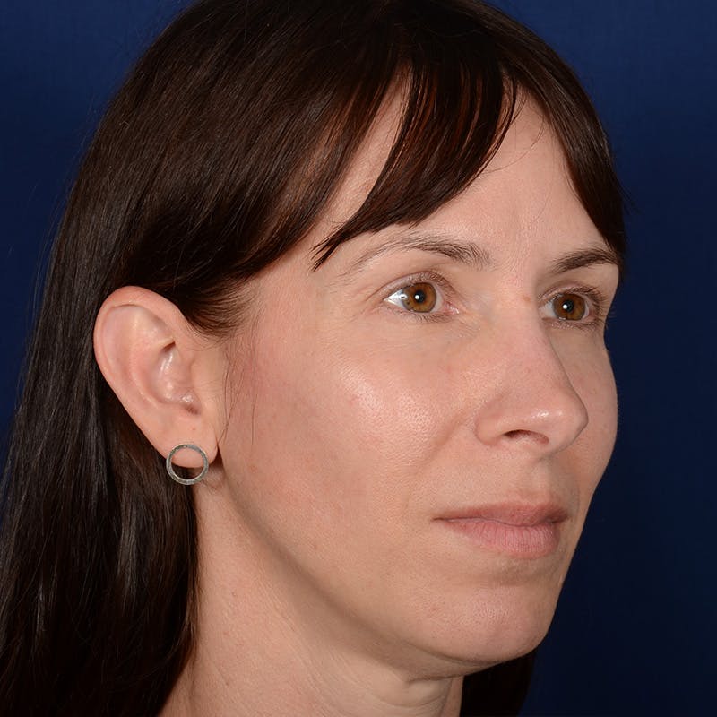 Chin Augmentation Before & After Gallery - Patient 121334 - Image 3