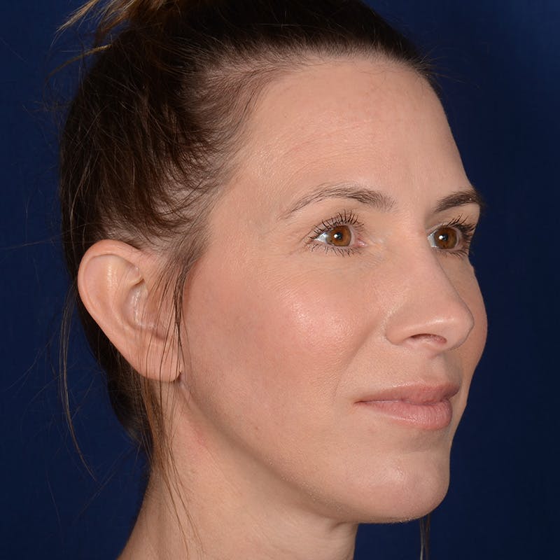 Chin Augmentation Before & After Gallery - Patient 121334 - Image 4