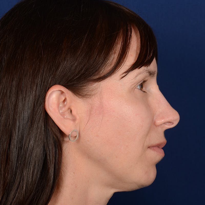 Chin Augmentation Before & After Gallery - Patient 121334 - Image 5