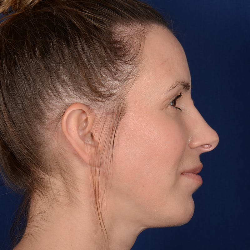 Chin Augmentation Before & After Gallery - Patient 121334 - Image 6