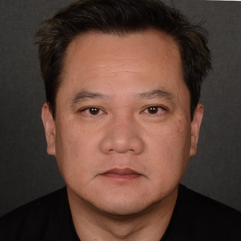 Chin Augmentation Before & After Gallery - Patient 279809 - Image 1