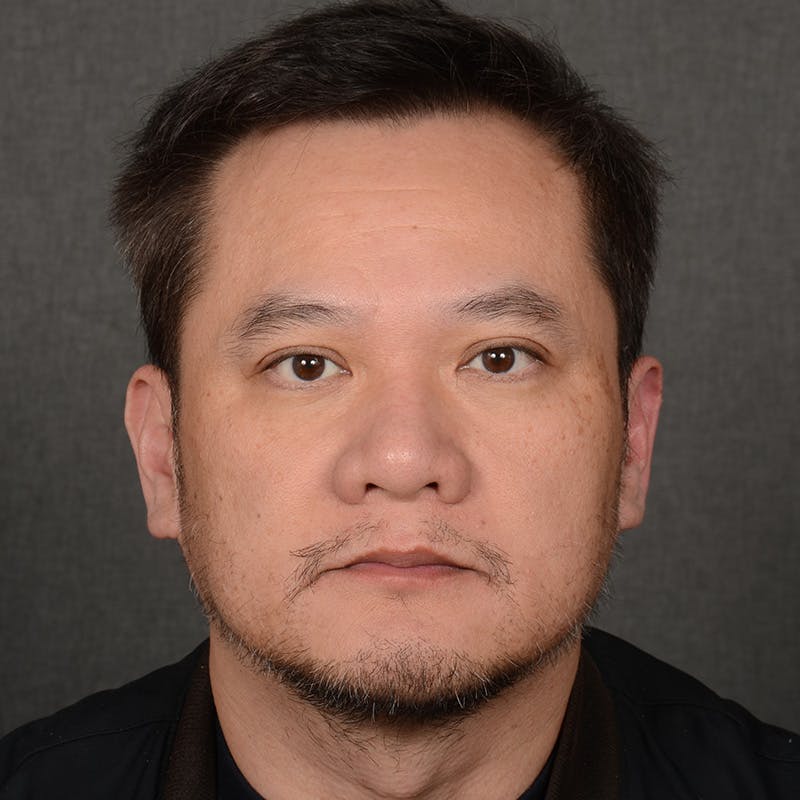 Chin Augmentation Before & After Gallery - Patient 279809 - Image 2