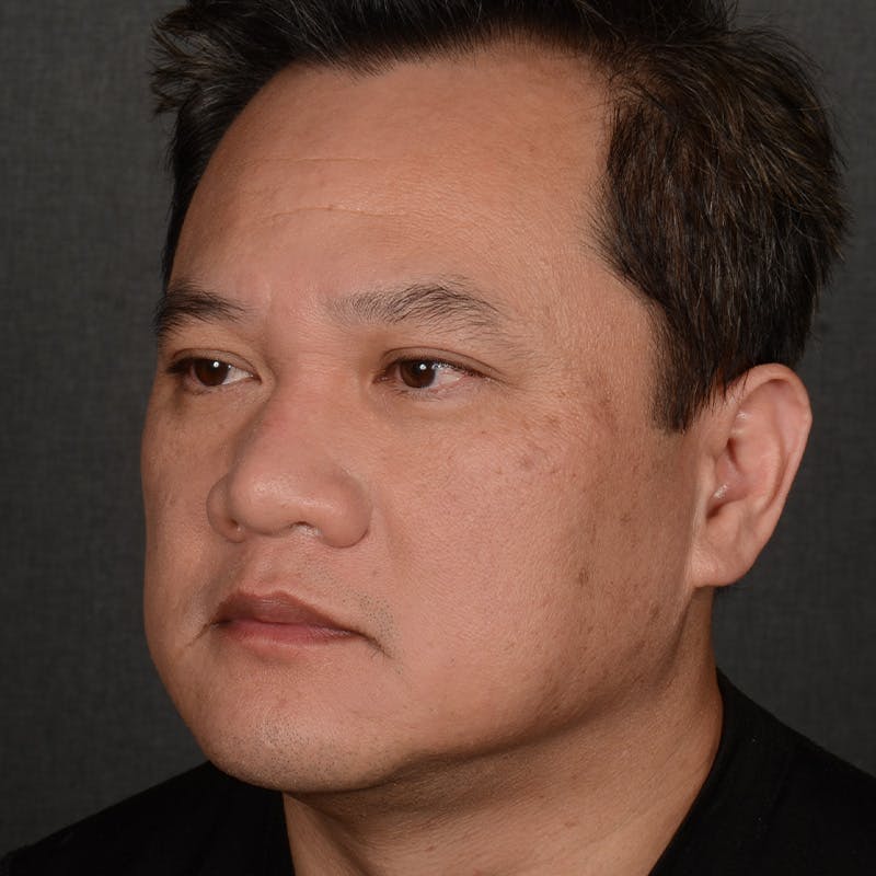 Chin Augmentation Before & After Gallery - Patient 279809 - Image 3