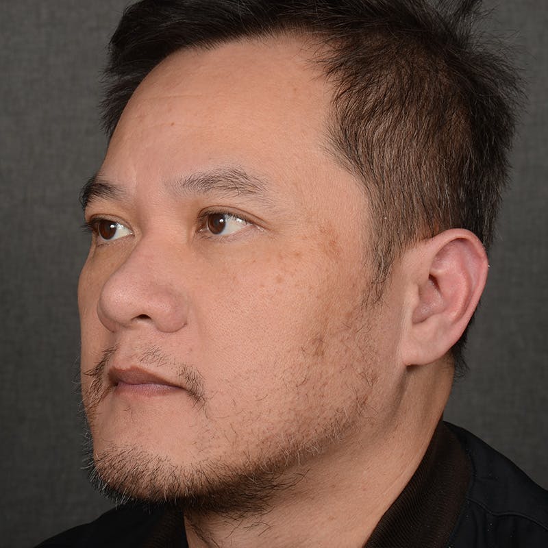 Chin Augmentation Before & After Gallery - Patient 279809 - Image 4