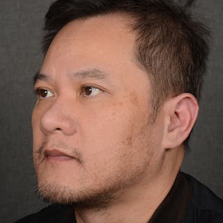 Chin Augmentation Before & After Gallery - Patient 279809 - Image 4