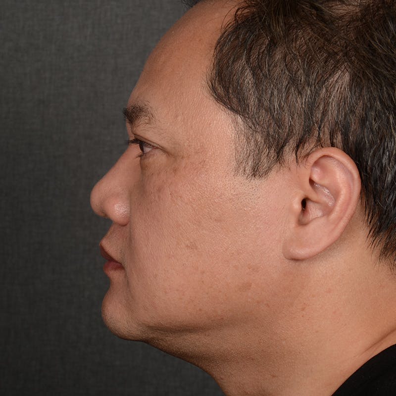 Chin Augmentation Before & After Gallery - Patient 279809 - Image 5