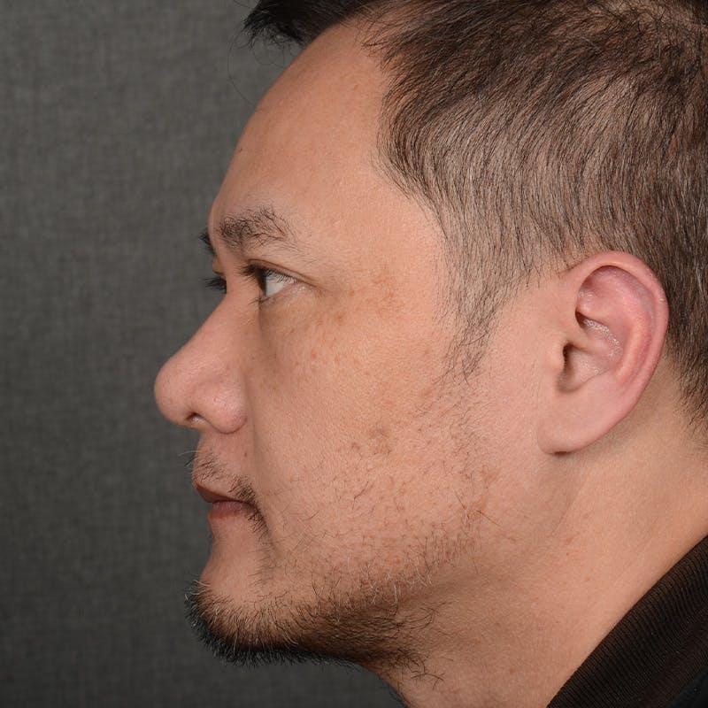 Chin Augmentation Before & After Gallery - Patient 279809 - Image 6