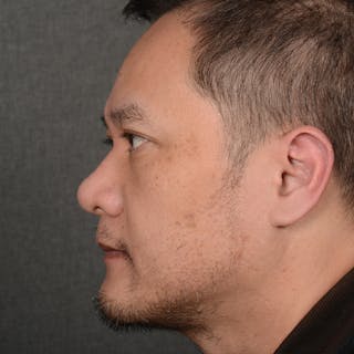 Chin Augmentation Before & After Gallery - Patient 279809 - Image 6