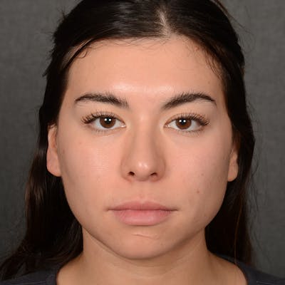 Female Rhinoplasty Before & After Gallery - Patient 418154 - Image 1