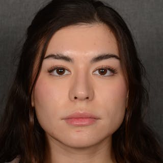 Chin Augmentation Before & After Gallery - Patient 936376 - Image 2
