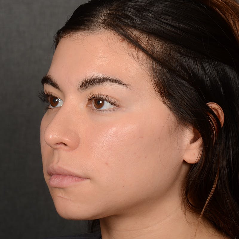 Chin Augmentation Before & After Gallery - Patient 936376 - Image 3