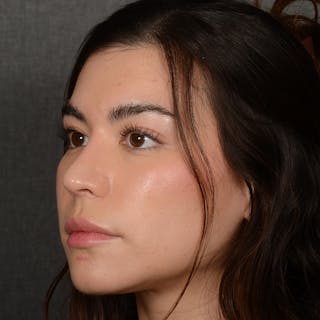 Chin Augmentation Before & After Gallery - Patient 936376 - Image 4