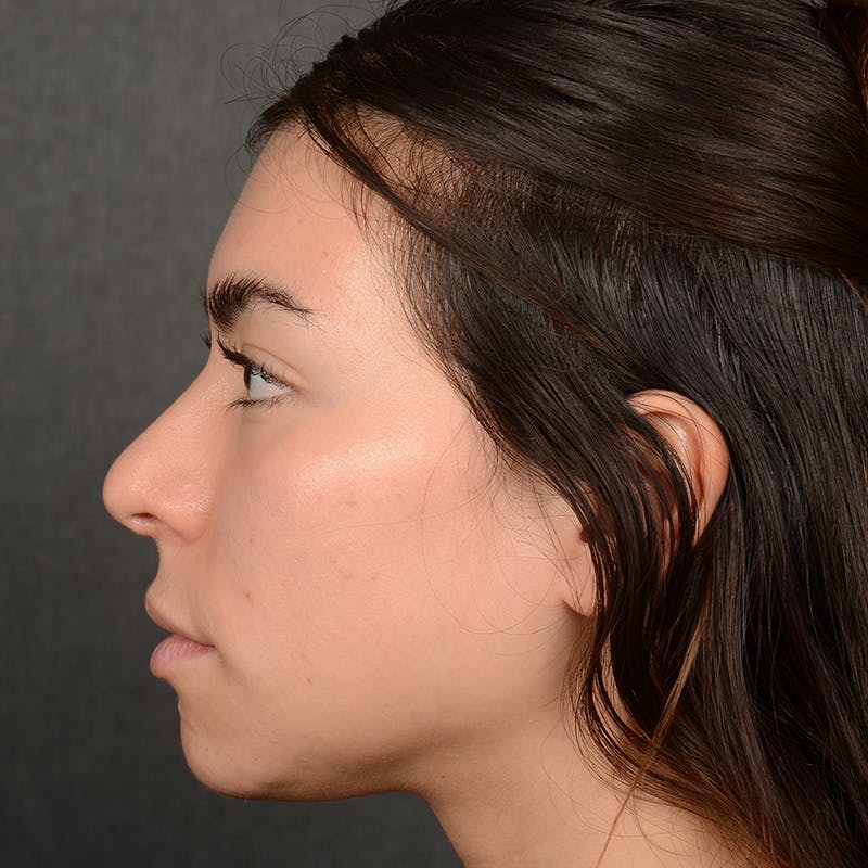 Chin Augmentation Before & After Gallery - Patient 936376 - Image 5