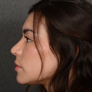 Chin Augmentation Before & After Gallery - Patient 936376 - Image 6