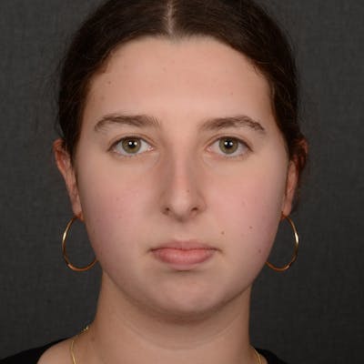 Female Rhinoplasty Before & After Gallery - Patient 415826 - Image 1