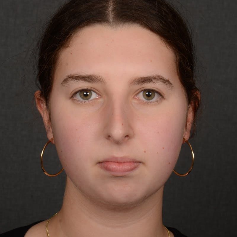 Chin Augmentation Before & After Gallery - Patient 225636 - Image 1