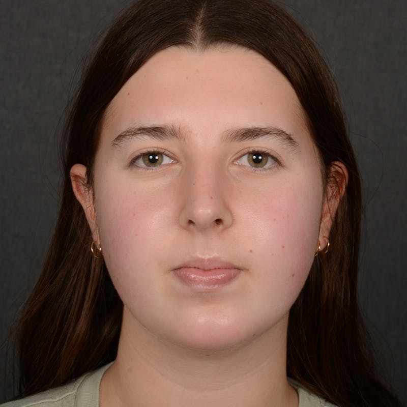 Chin Augmentation Before & After Gallery - Patient 225636 - Image 2