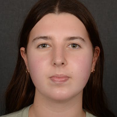 Chin Augmentation Before & After Gallery - Patient 225636 - Image 2