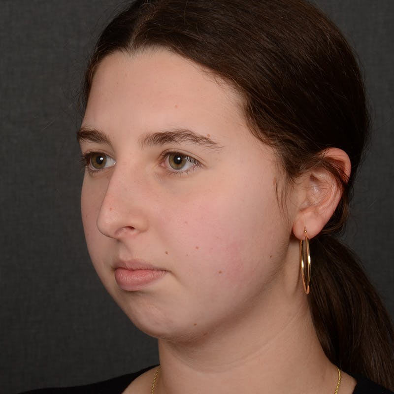 Chin Augmentation Before & After Gallery - Patient 225636 - Image 3