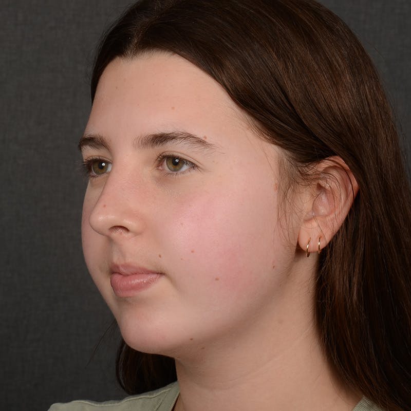 Chin Augmentation Before & After Gallery - Patient 225636 - Image 4