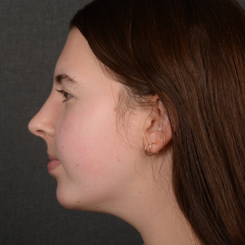 Chin Augmentation Before & After Gallery - Patient 225636 - Image 6