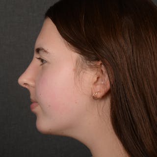 Female Rhinoplasty Before & After Gallery - Patient 415826 - Image 6