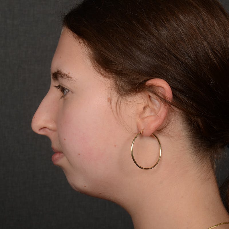 Chin Augmentation Before & After Gallery - Patient 225636 - Image 5