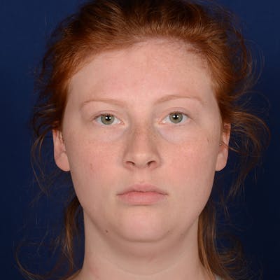 Chin Augmentation Before & After Gallery - Patient 125836 - Image 1