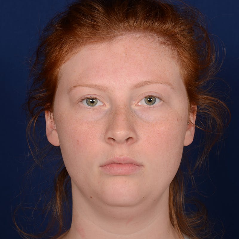 Chin Augmentation Before & After Gallery - Patient 125836 - Image 1