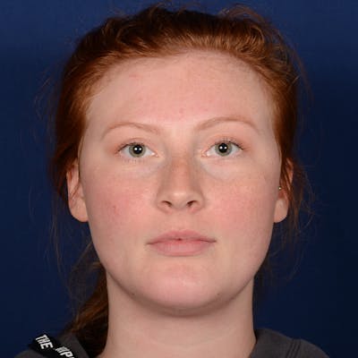 Chin Augmentation Before & After Gallery - Patient 125836 - Image 2