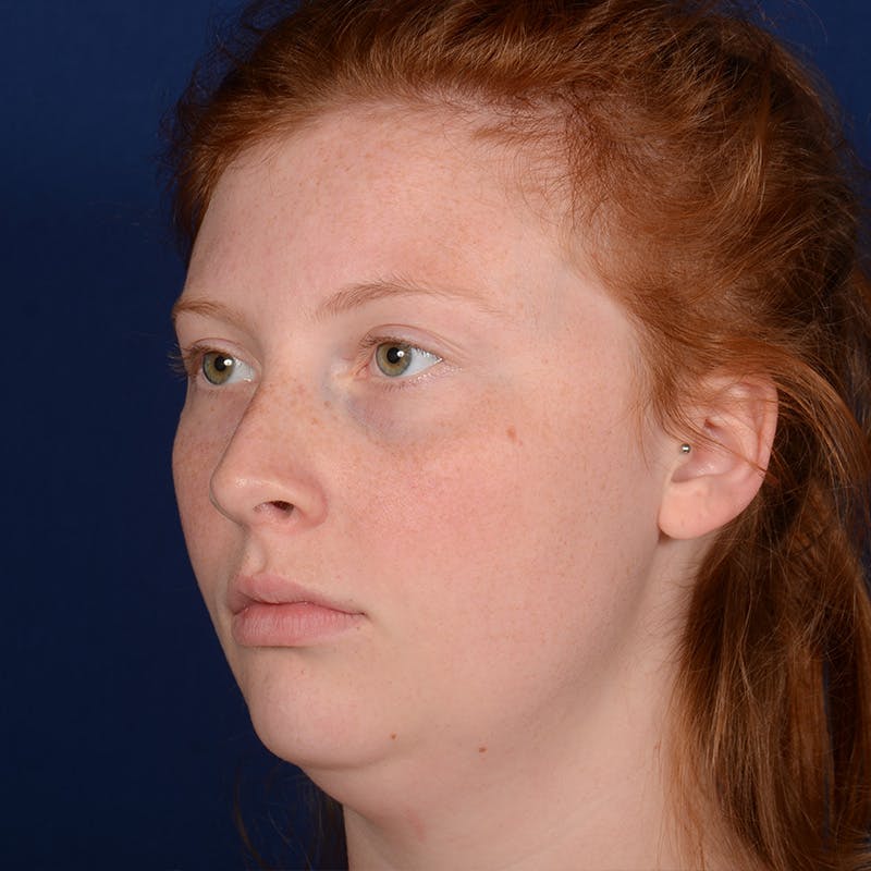 Chin Augmentation Before & After Gallery - Patient 125836 - Image 3