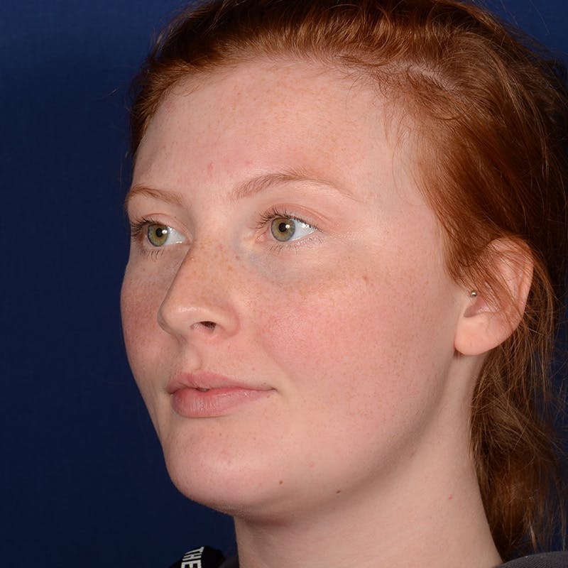 Chin Augmentation Before & After Gallery - Patient 125836 - Image 4