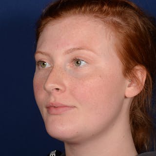 Chin Augmentation Before & After Gallery - Patient 125836 - Image 4