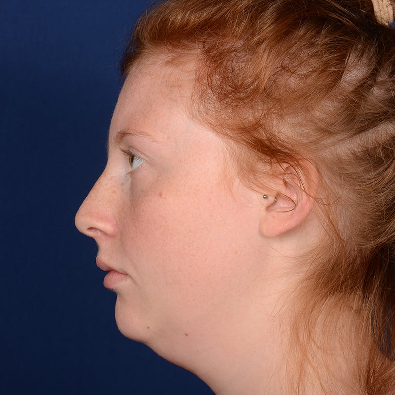 Chin Augmentation Before & After Gallery - Patient 125836 - Image 5
