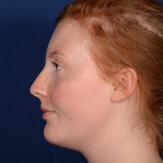 Chin Augmentation Before & After Gallery - Patient 125836 - Image 6