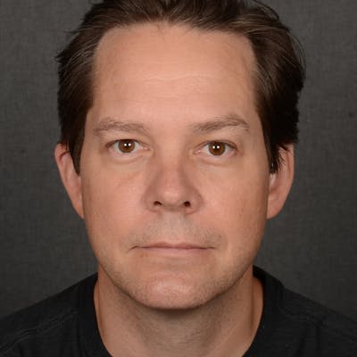 Chin Augmentation Before & After Gallery - Patient 104242 - Image 1